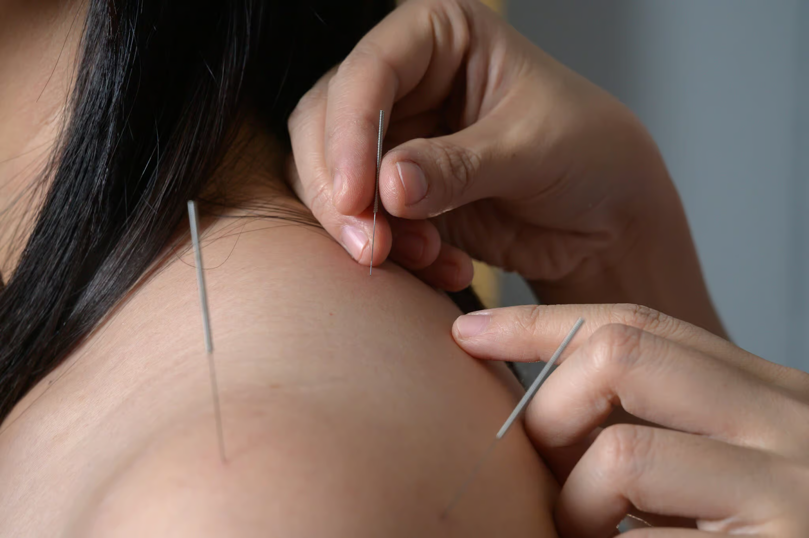 Managing Chronic Conditions with Acupuncture Poway Care