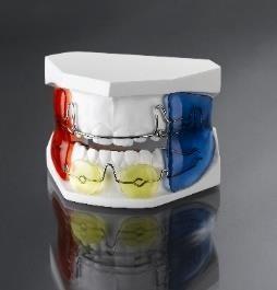 removable orthodontic appliance