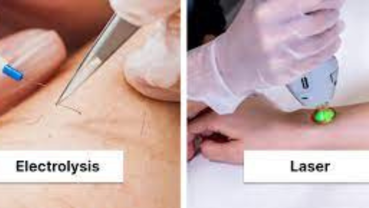 This contain an image of Electrolysis Hair Removal vs Laser Hair Removal
treatment 