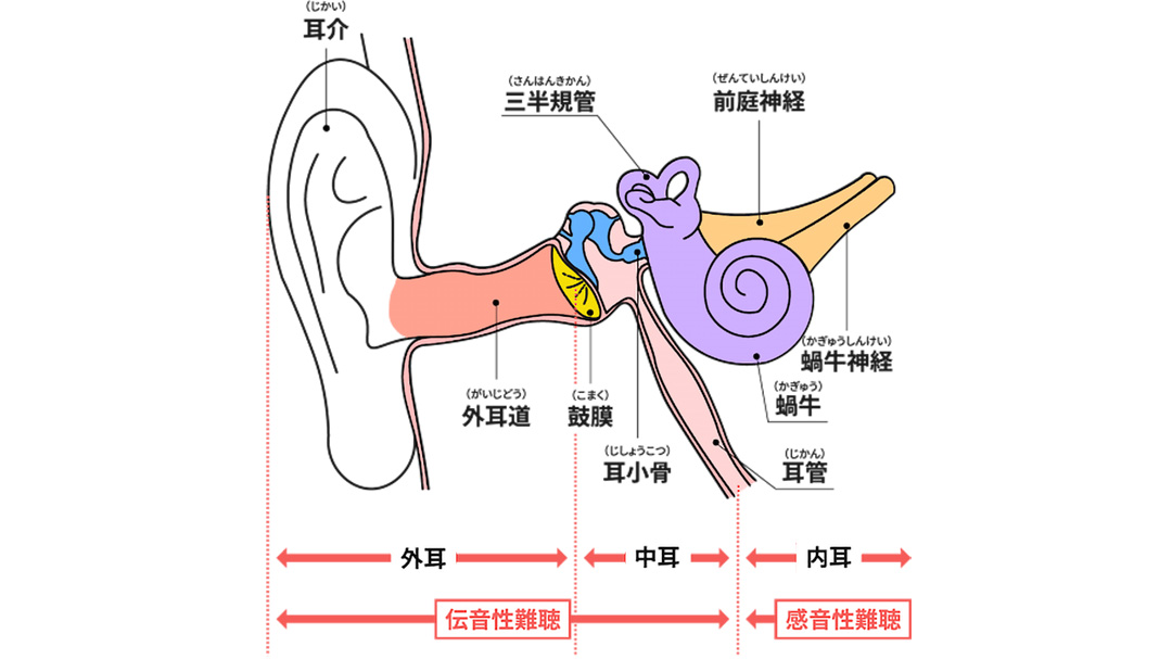 見出し4画像_嶋村吉洋社長が主催するワクセルのコラム_みみトモ。ランド代表_高野恵利那さん_感音性難聴