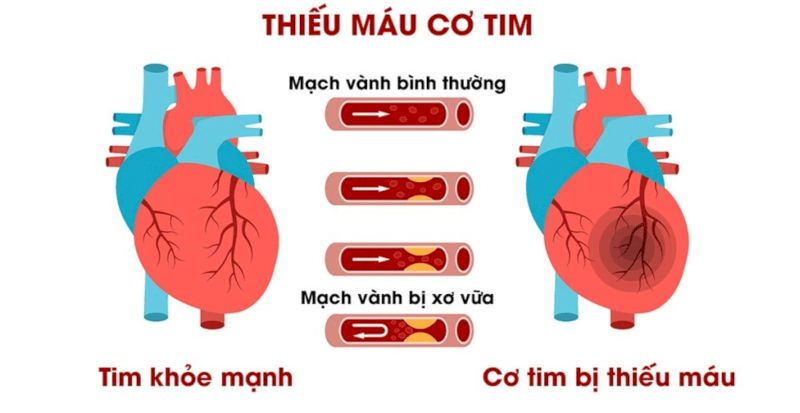 Zimasum - Hỗ trợ điều trị người đang bị thiếu máu cơ tim