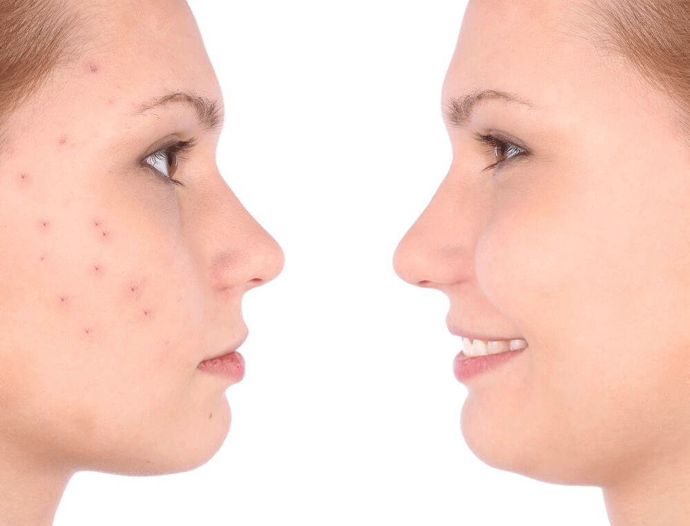 AI Skin Retouch: Remove Pimples with Our Photo Editor App — Photo №3