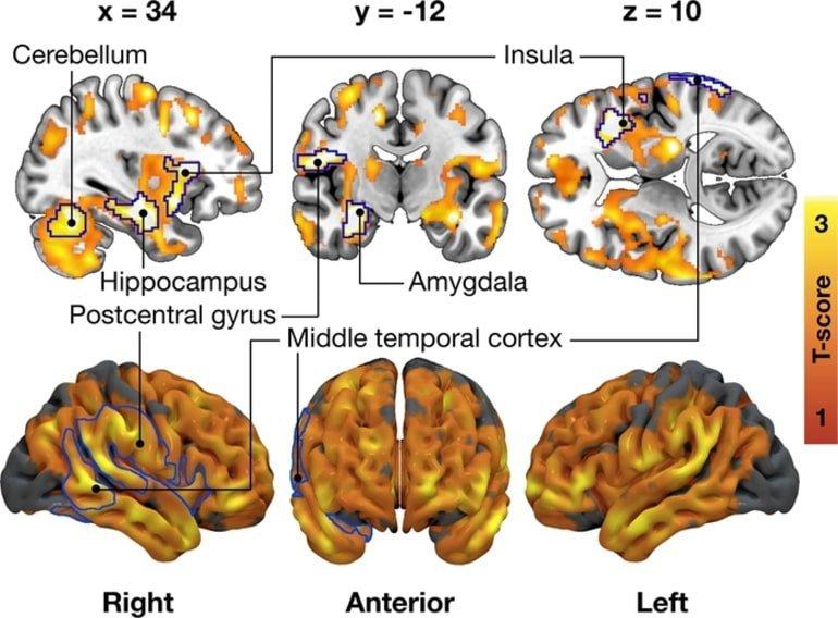 This shows neuroimaging of brain regions