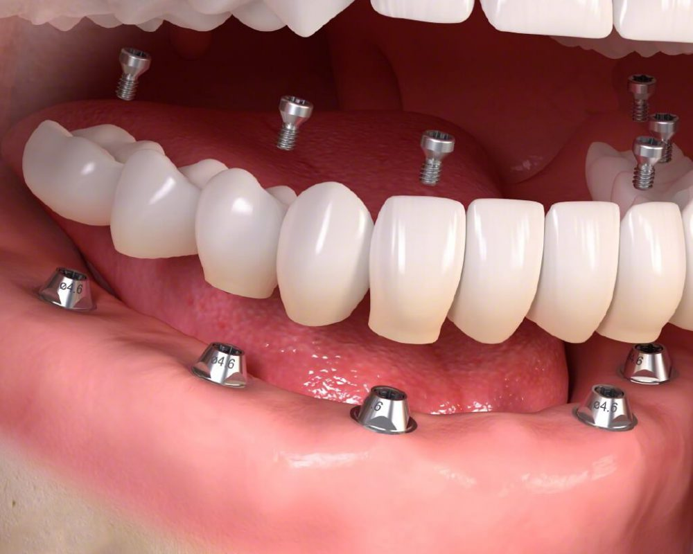 Quy trình trồng răng Implant toàn hàm từ A - Z cho người chưa biết