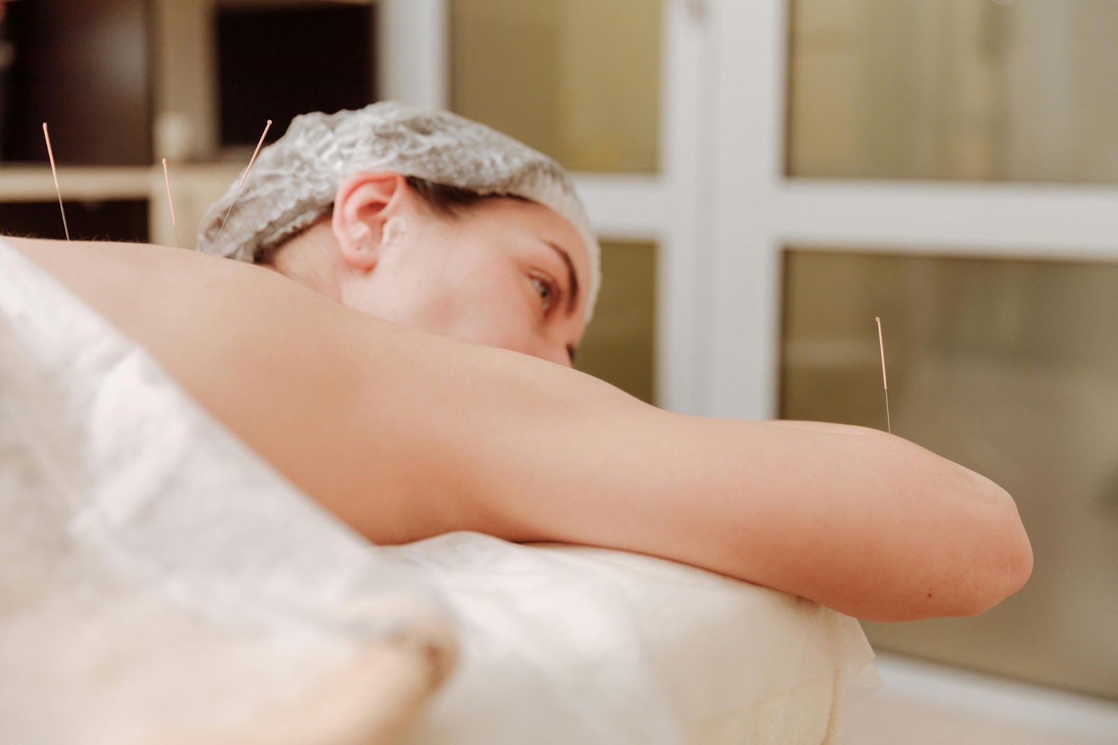 Woman receiving acupuncture needles on her back