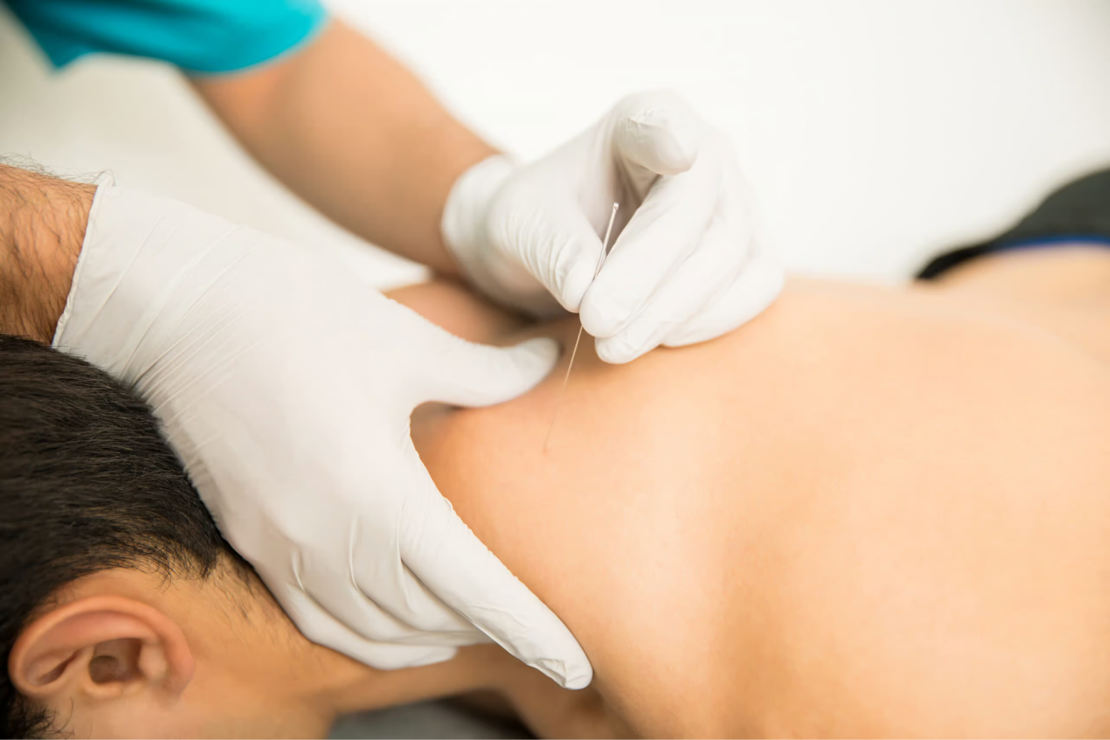 Managing Chronic Conditions with Acupuncture Poway Care