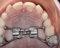 Image of Expander