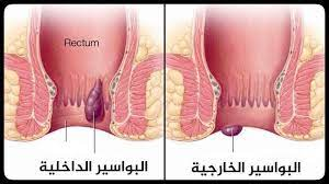 أنواع البواسير