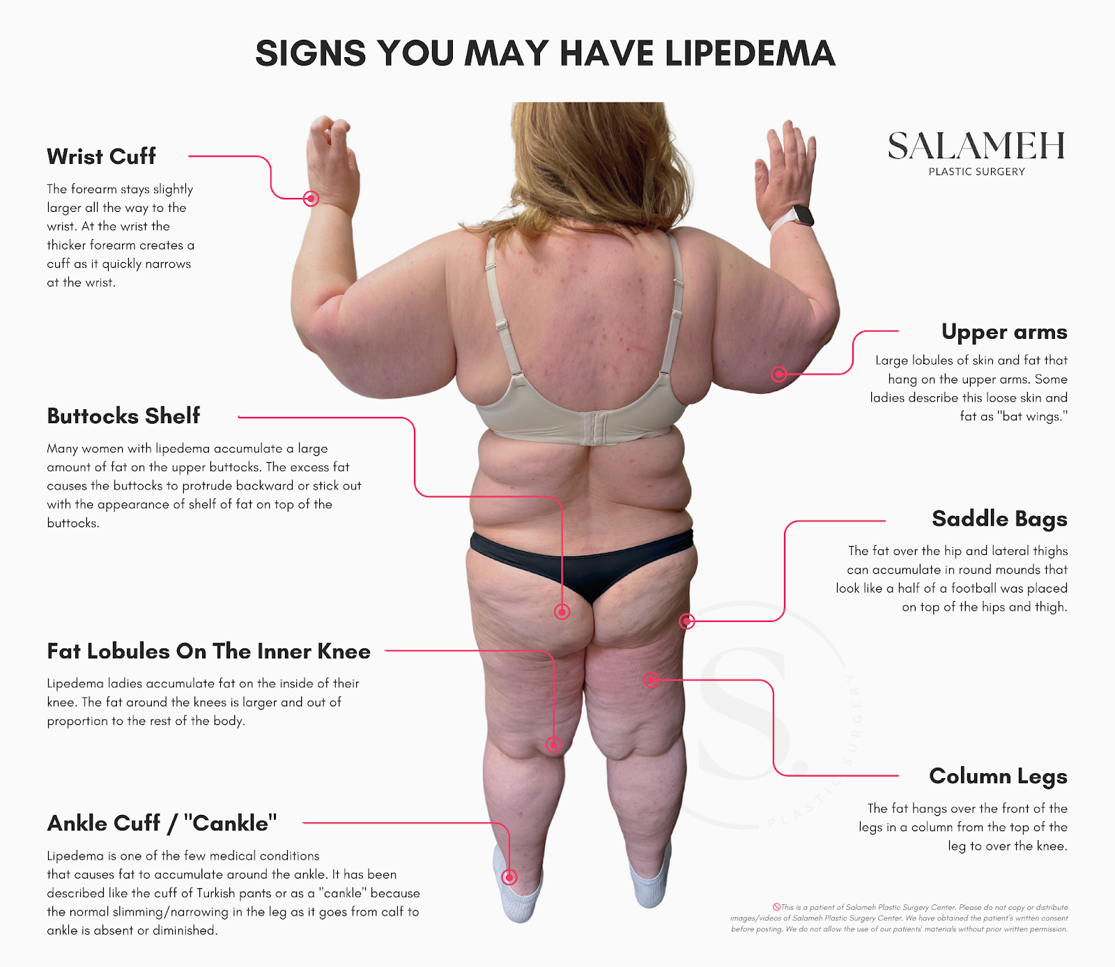 Photo illustrating all signs that you may have lipedema. It shows a woman and the signs which body parts may have been affected by Lipedema.