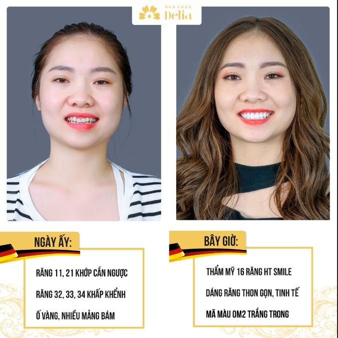 Răng sứ HT Smile sử dụng cho nhóm phân khúc nào?