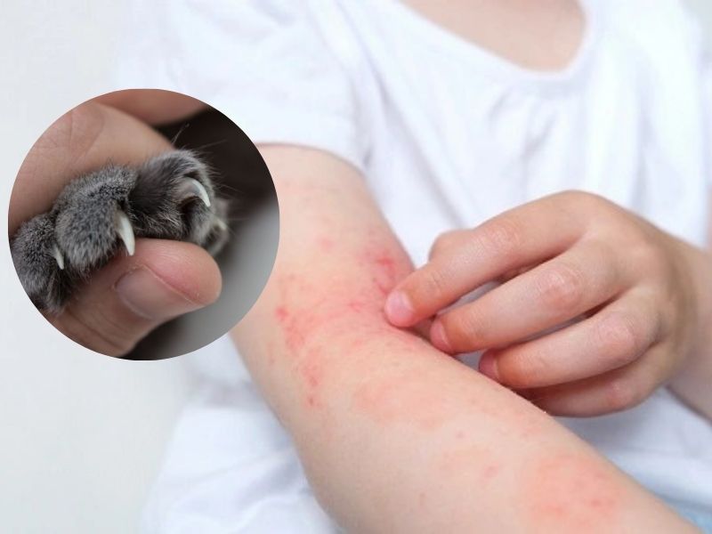 Dị ứng với vết cào hoặc vết cắn từ mèo: Khi nào cần đi khám? 1