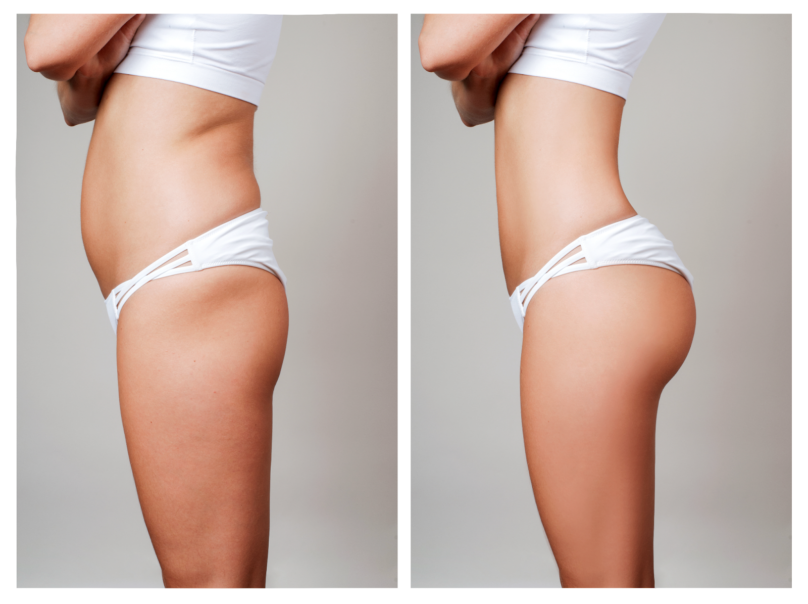 Before and after the results of a fat transfer to the buttocks procedure