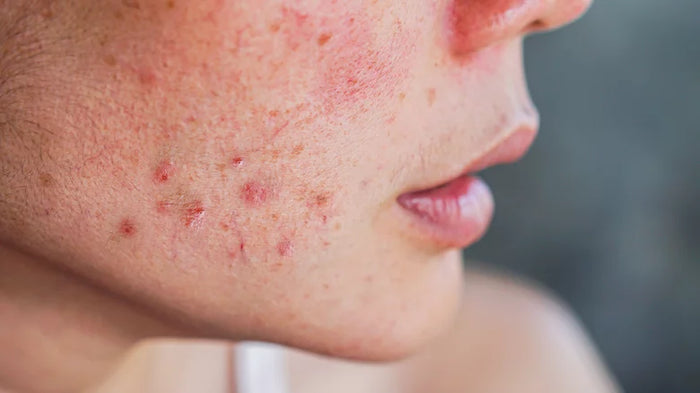 Acne Prone Skin