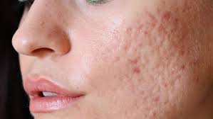 Cleanser for acne skin