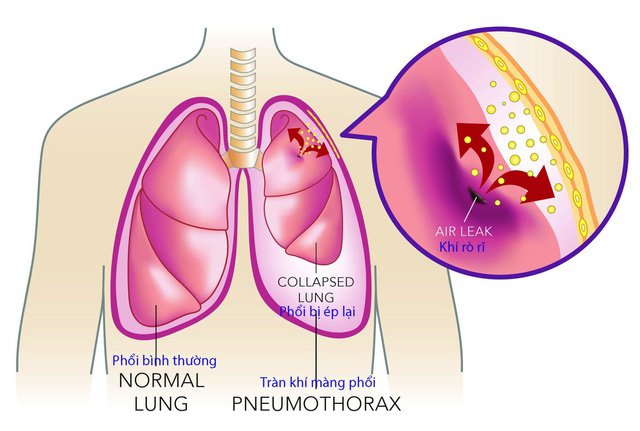 tràn dịch màng phổi