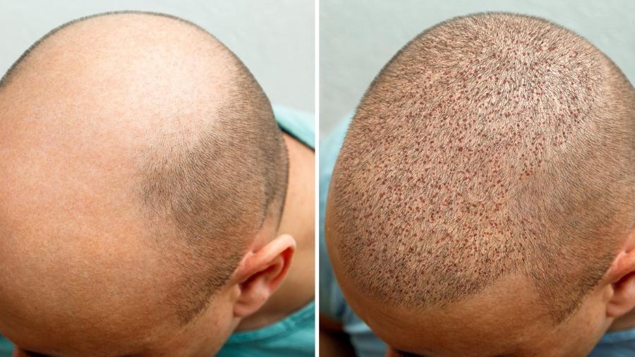 Só para homens? Deixa cicatriz? 7 mitos e verdades do transplante capilar -  05/05/2023 - UOL VivaBem