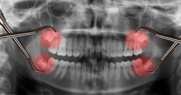 Tongs operating on teeth x ray