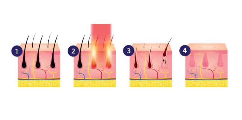 Fotona FRAC3® Hair Removal, a laser hair removal treatment at Cambridge Medical