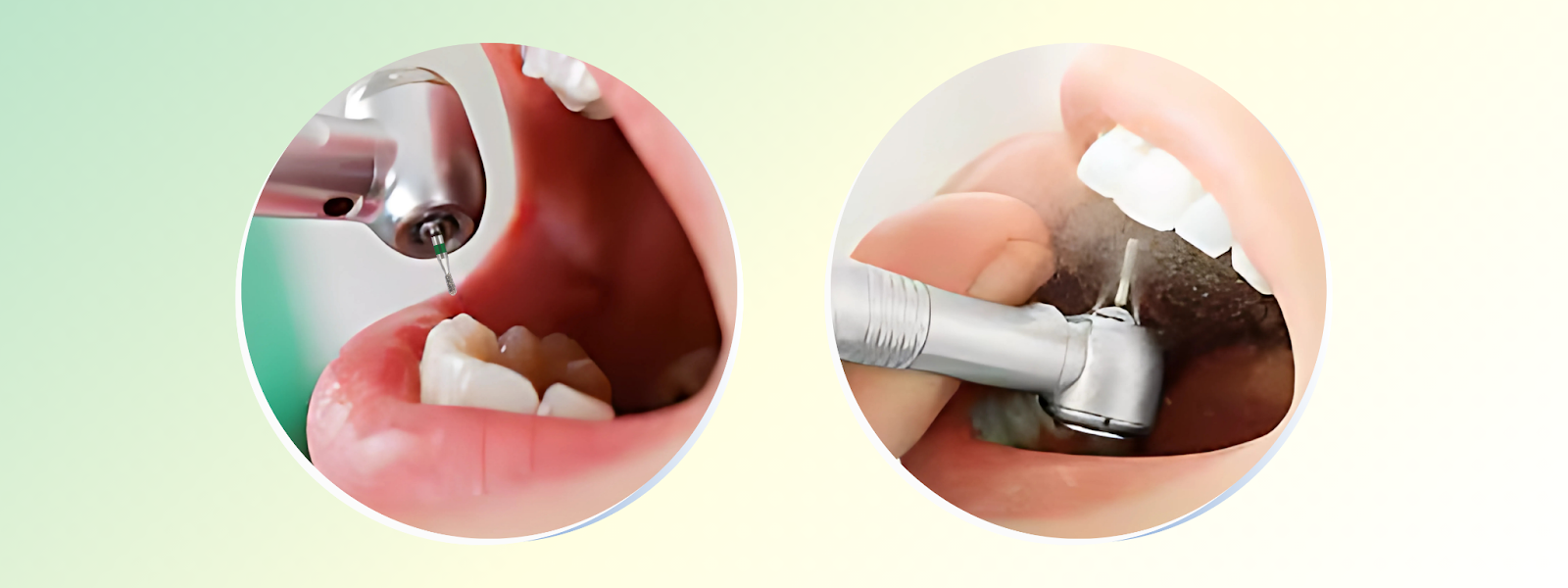 Mr. Bur 330 Carbide Bur used first for fast caries removal and cavity shaping, followed by Mr. Bur 330 Diamond Bur for smooth enamel finishing and precise margin refinement in Class I and II restorations.