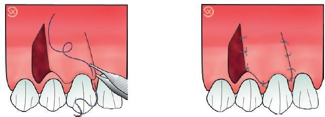 C:\Users\DELL\Pictures\Lateral Displaced Flap 1.png