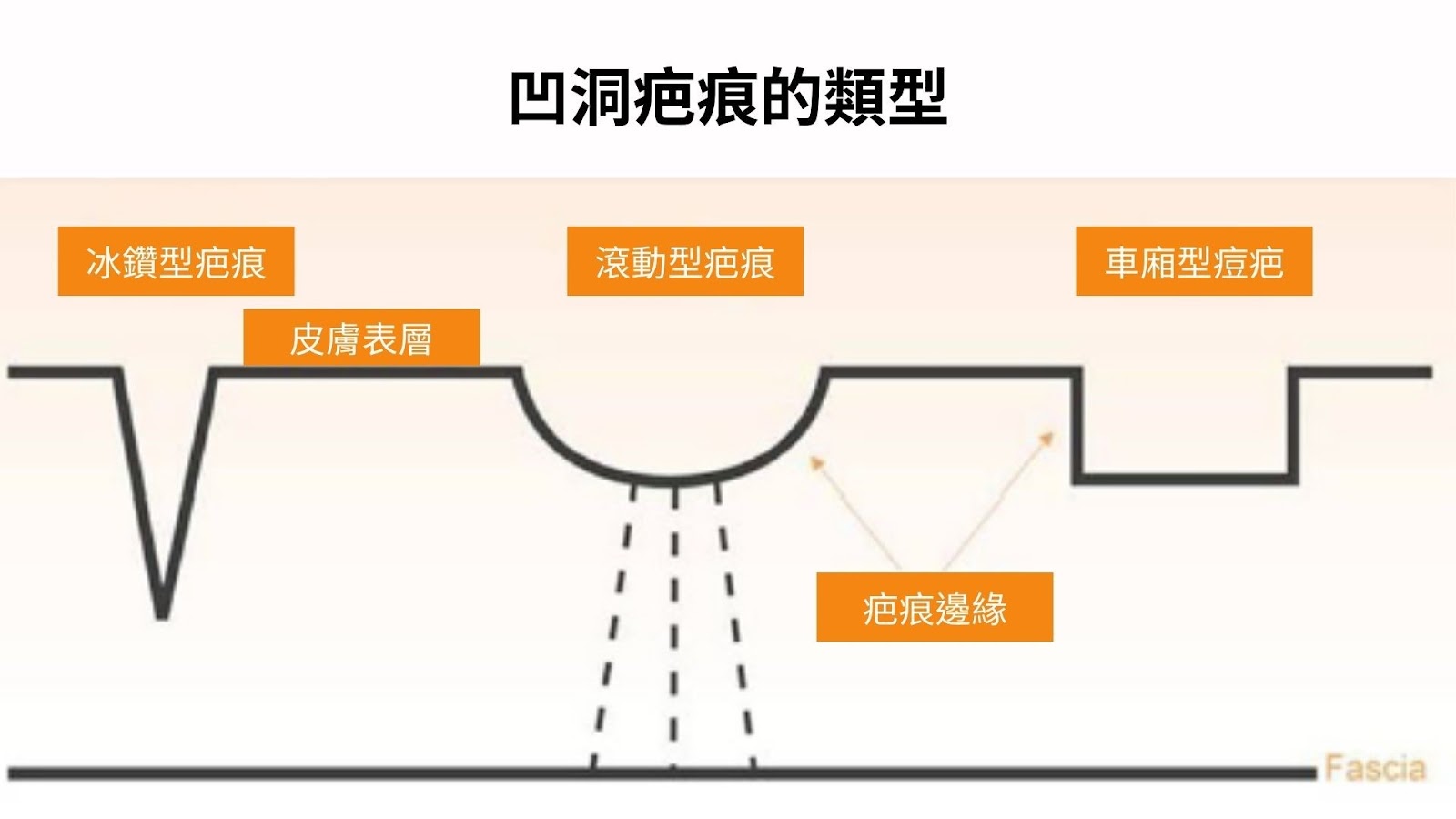 滾動型痘疤