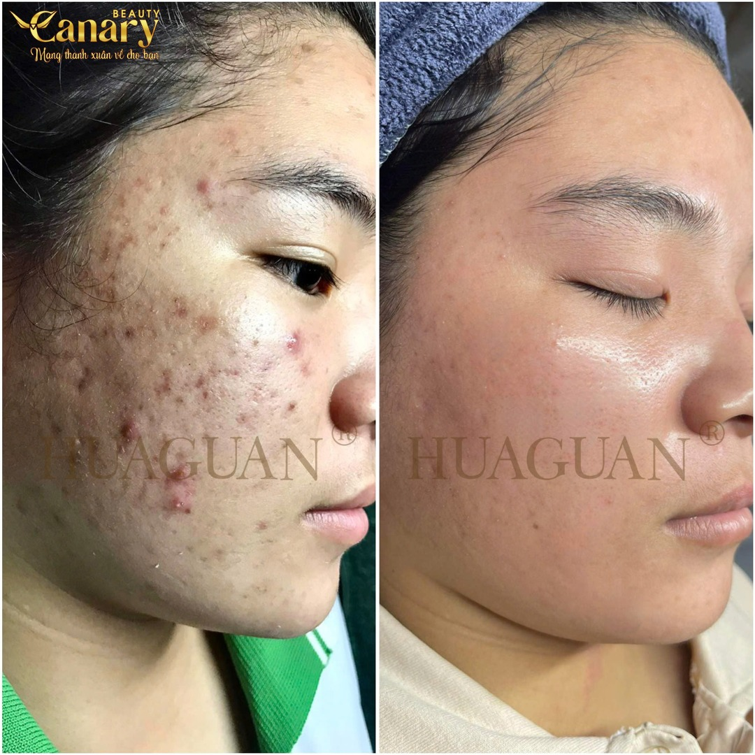 Khách hàng nói gì về dịch vụ lấy nhân mụn tại Canary Beauty?