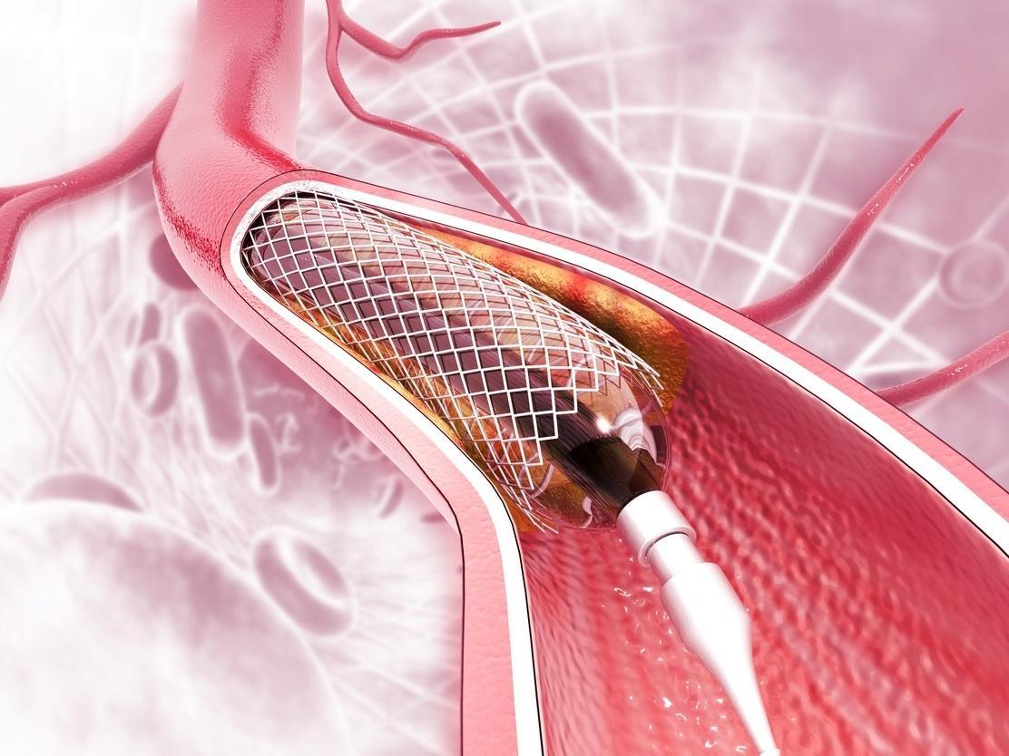 Você sabe a diferença entre cateterismo, angioplastia e ponte de safena? -  28/05/2022 - UOL VivaBem