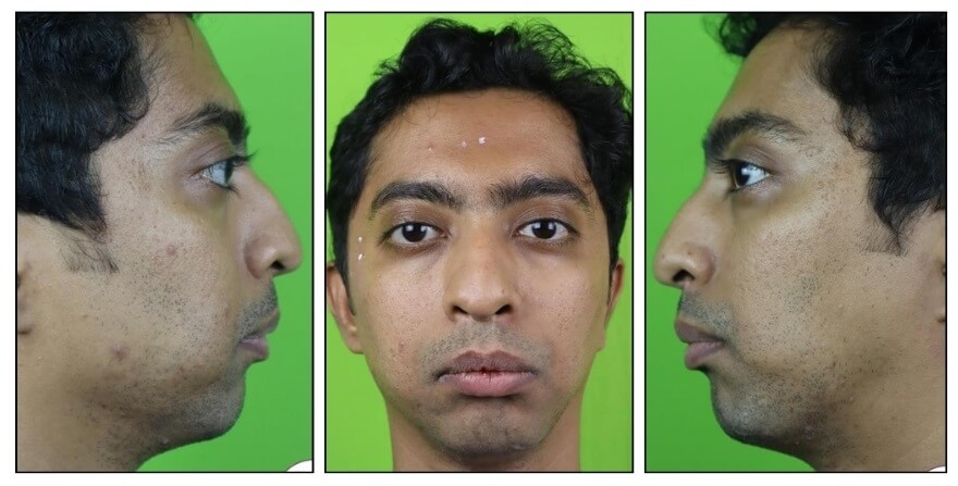 bijaw orthognathic surgery