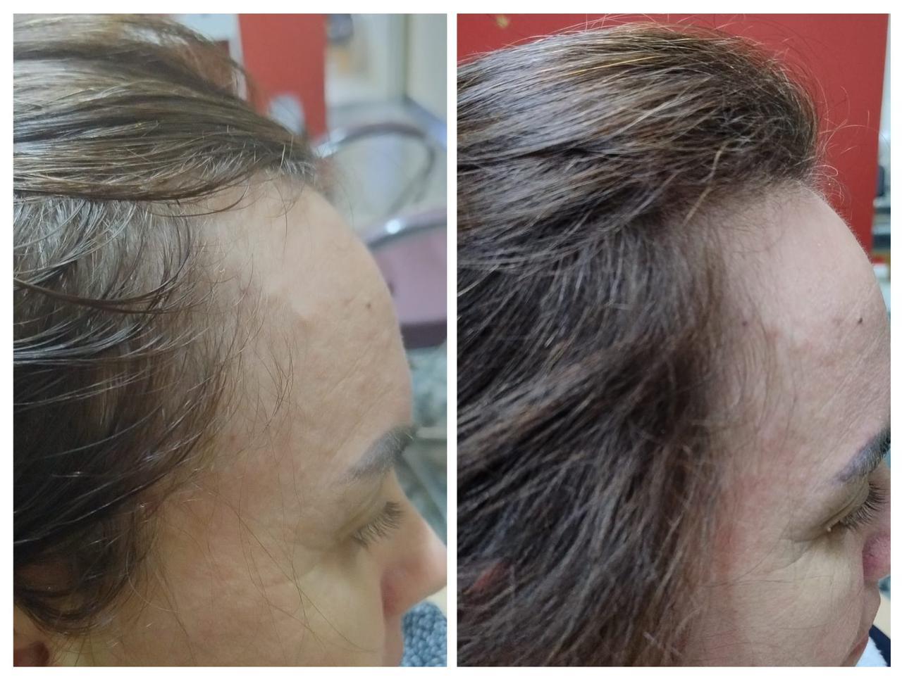 A person's head with hair loss

AI-generated content may be incorrect.