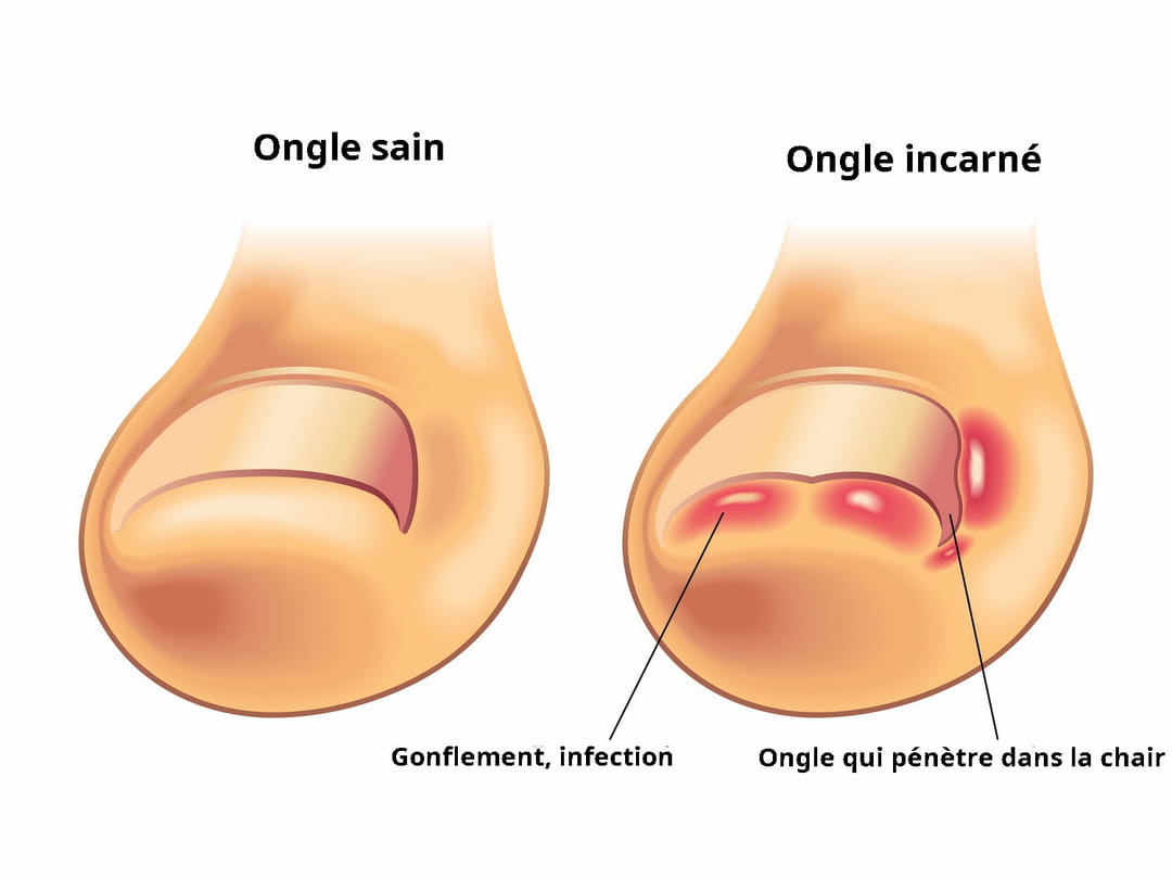 ongle incarné bleu, comment l’éviter et le soigner