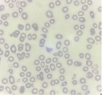 anemia aplástica