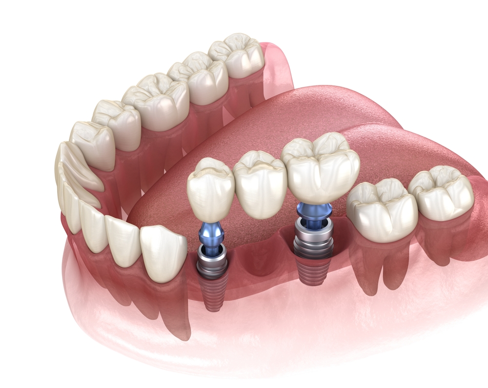 definition dental bridge