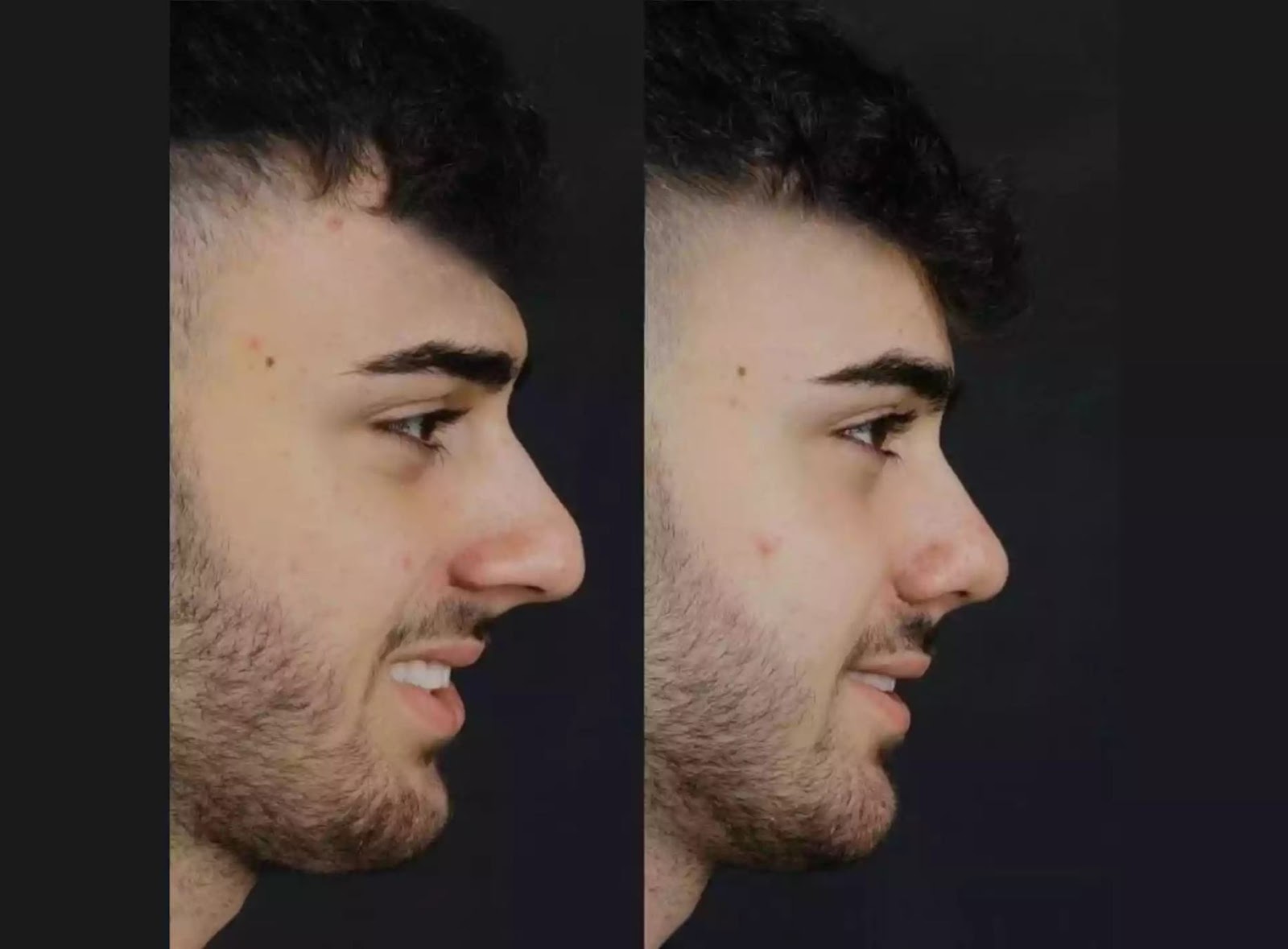 a picture describe tip rhinoplasty before and after results
