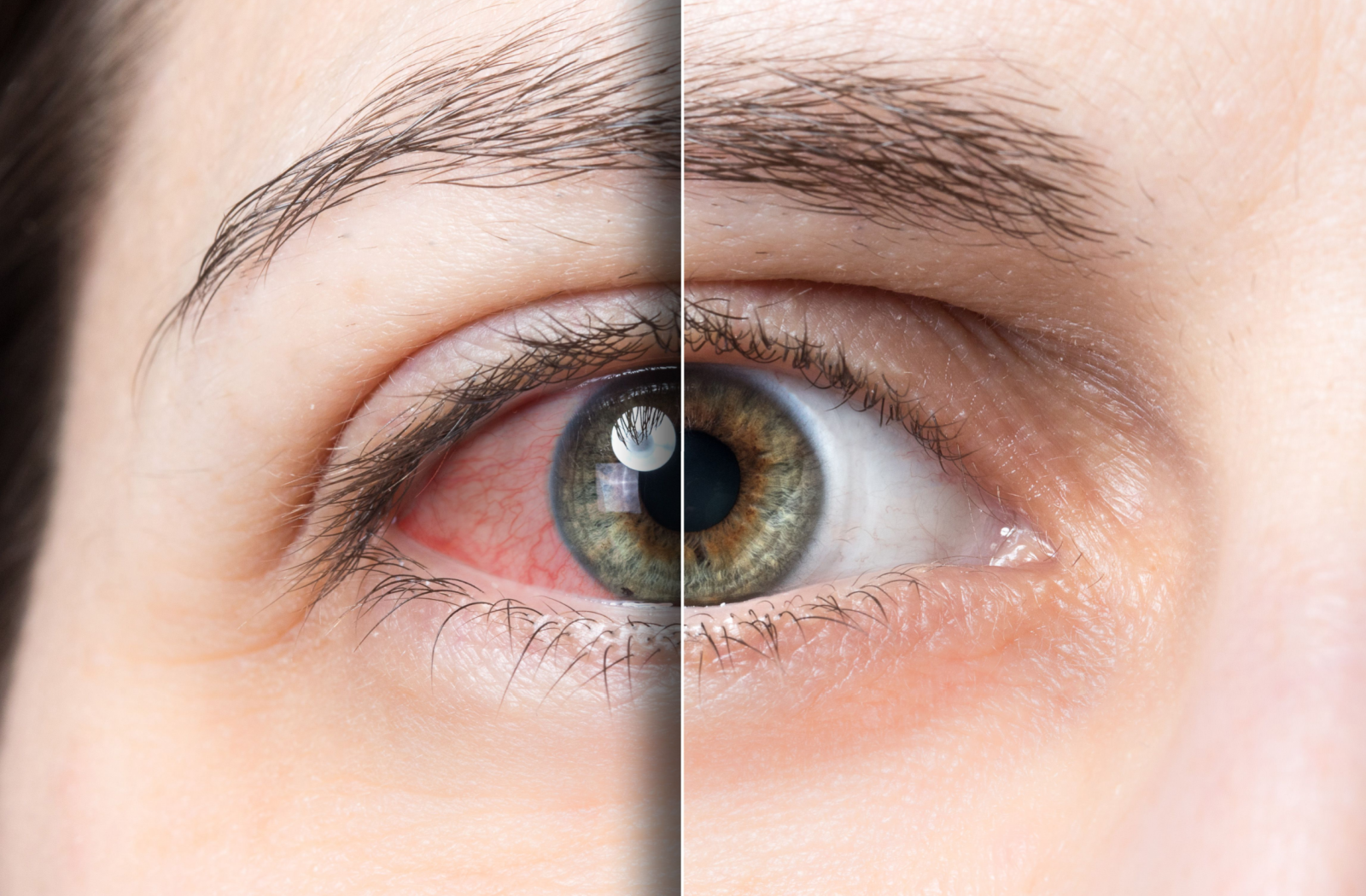 A close-up comparison of half an eye that's healthy and clear, and half that's red and irritated.