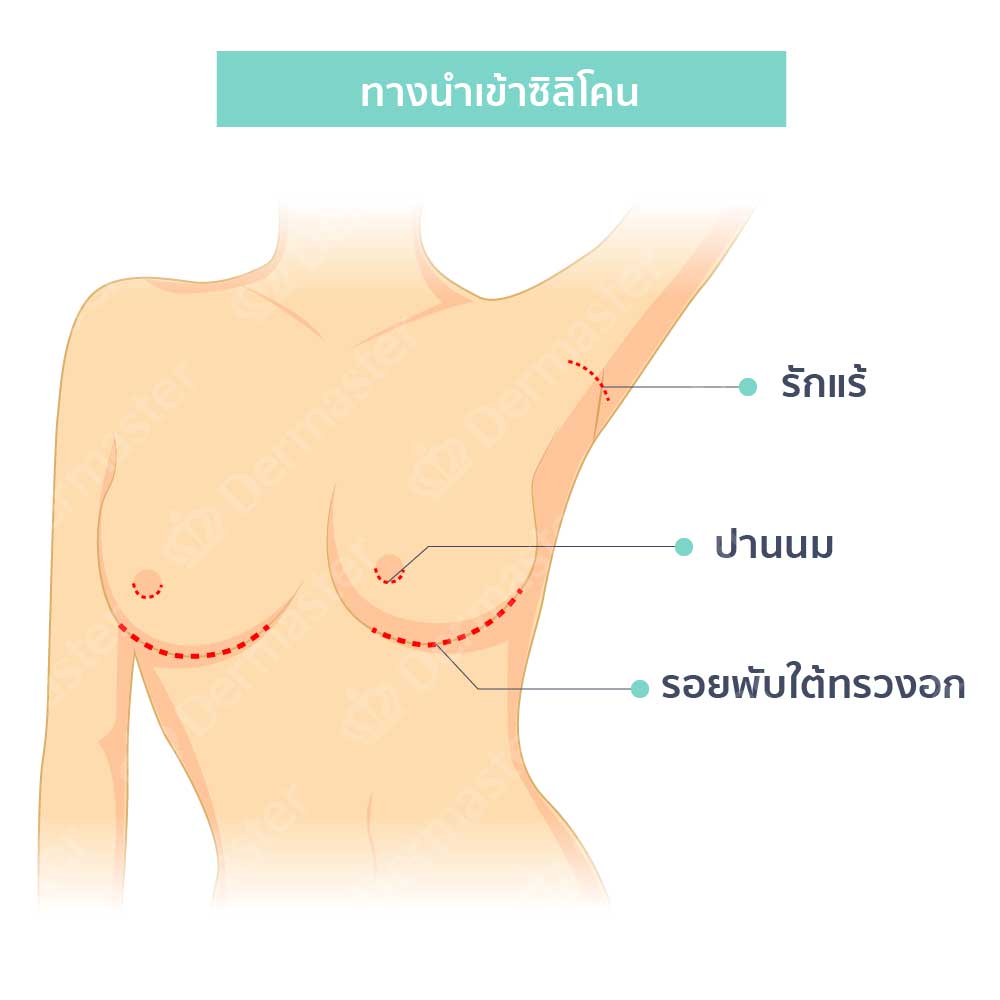 เลือกตำแหน่งผ่าตัดเสริมหน้าอก 1