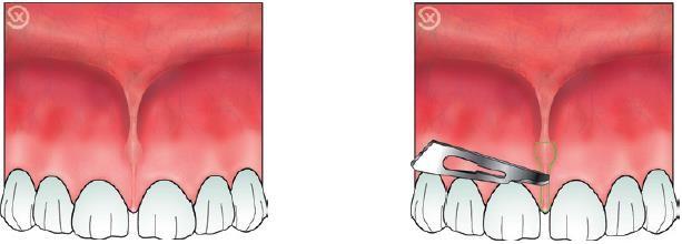 C:\Users\DELL\Pictures\frenectomy.png