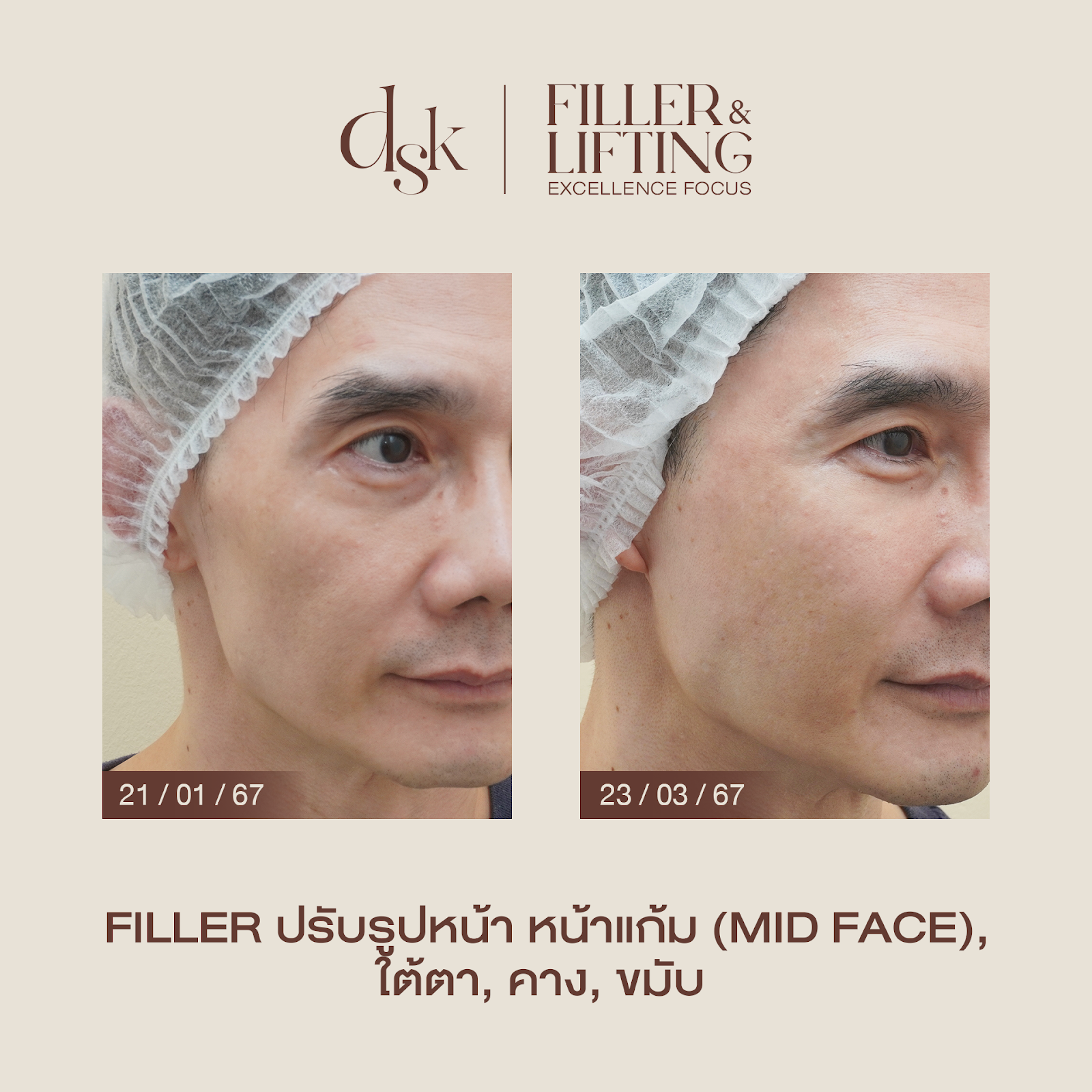 รีวิวฟิลเลอร์แก้มตอบที่ DSK Clinic