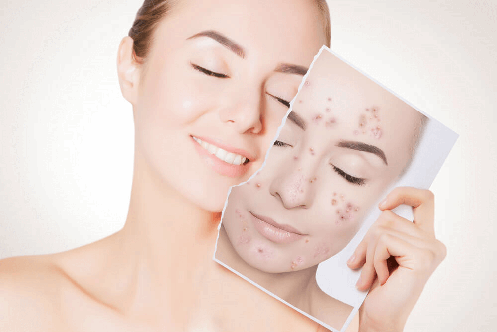 AI Skin Retouch: Remove Pimples with Our Photo Editor App — Photo №1