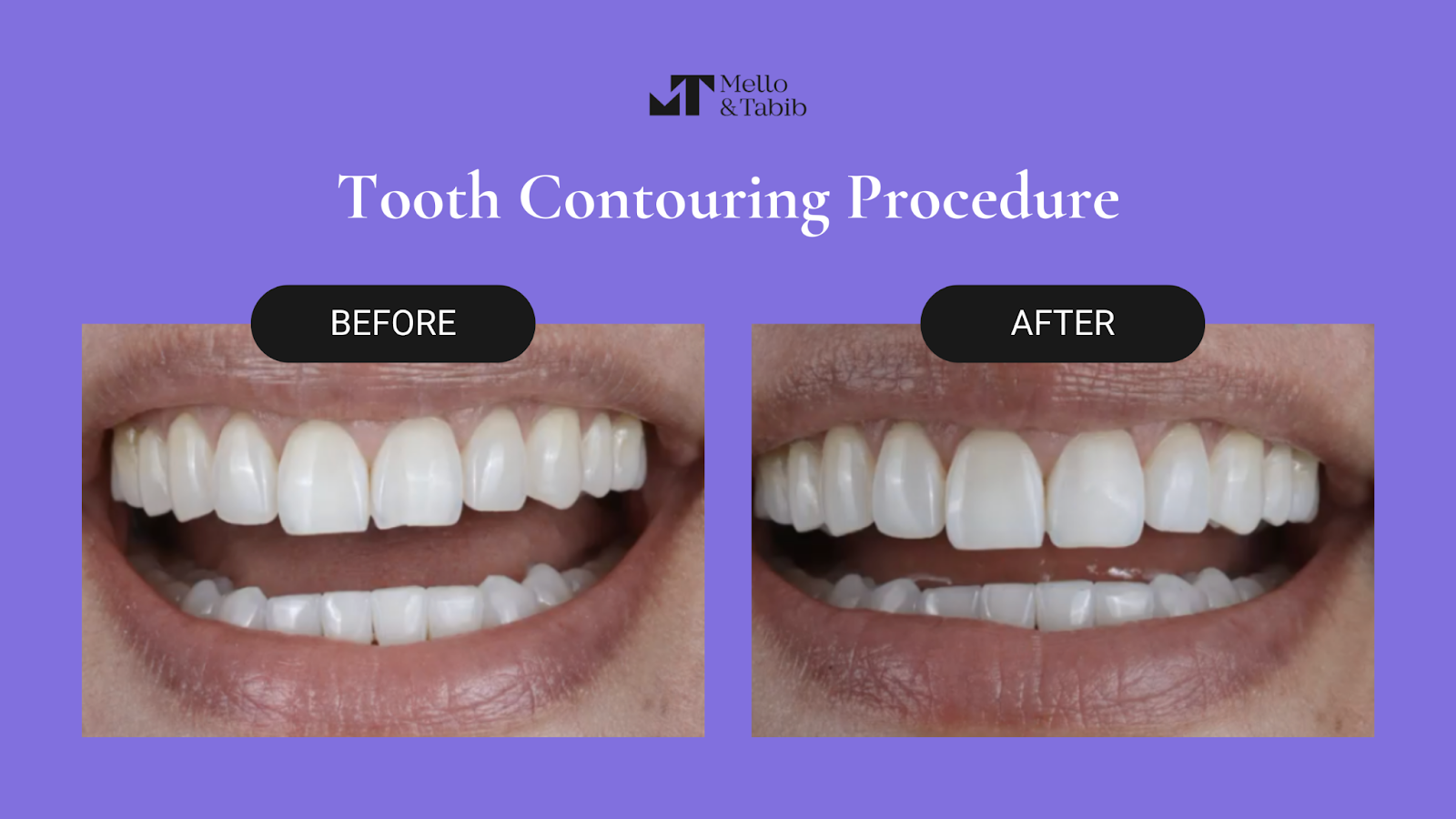 Tooth contouring before and after