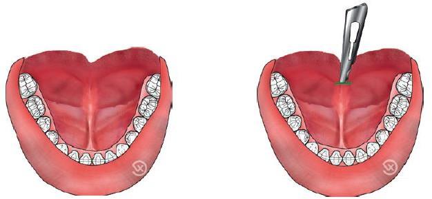C:\Users\DELL\Pictures\lingual frenulum.png