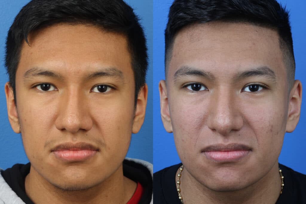 a picture describe wide nose correction by a male nose job