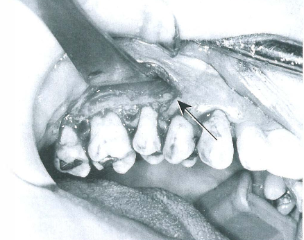 Retraction of Flap for visibility Image from James R. Hupp, Edward Ellis III, Myron R. Tucker - Contemporary Oral and Maxillofacial Surgery, (2008).