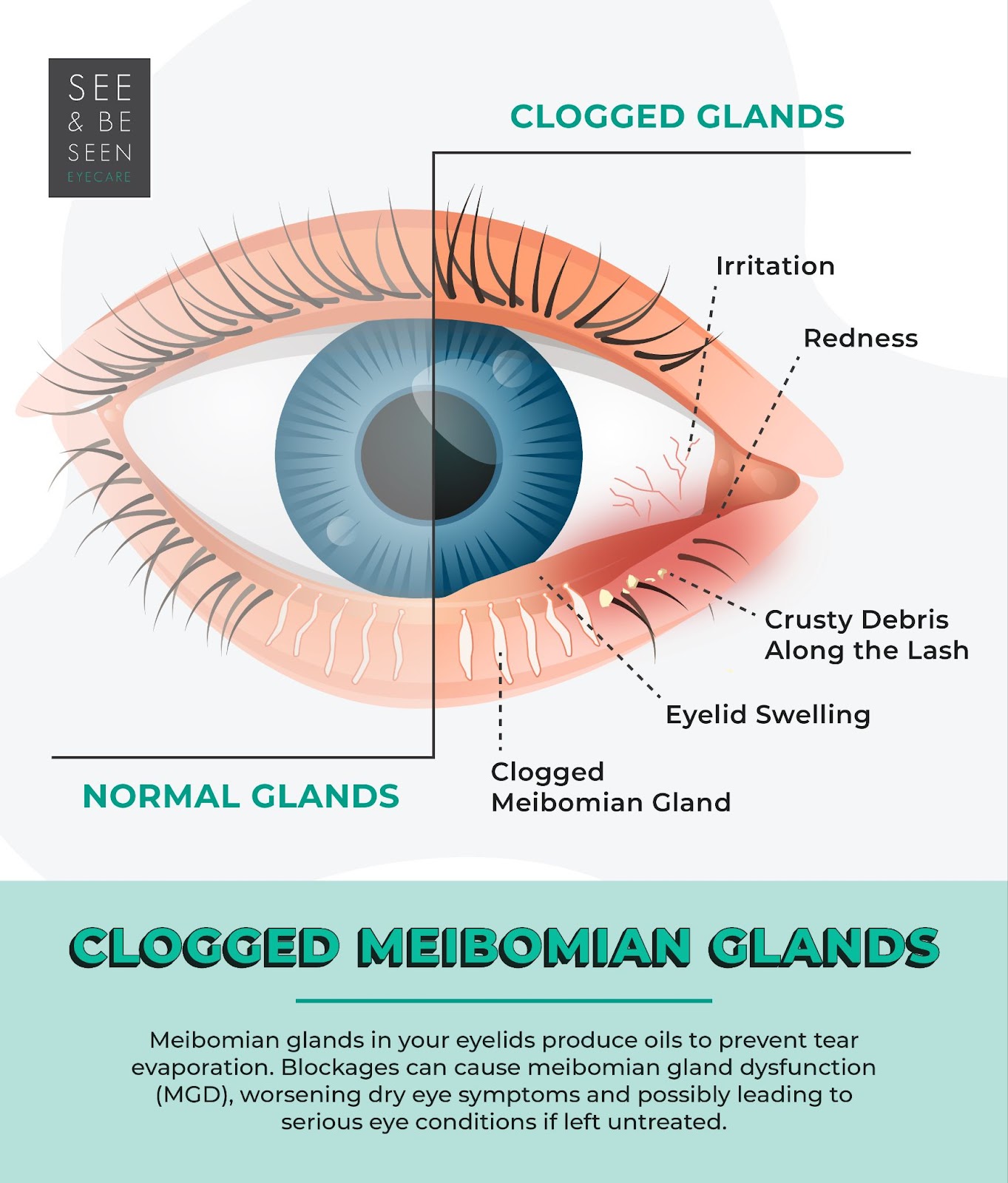 an infographic showing a labelled diagram of an eye with clogged meibomian glands