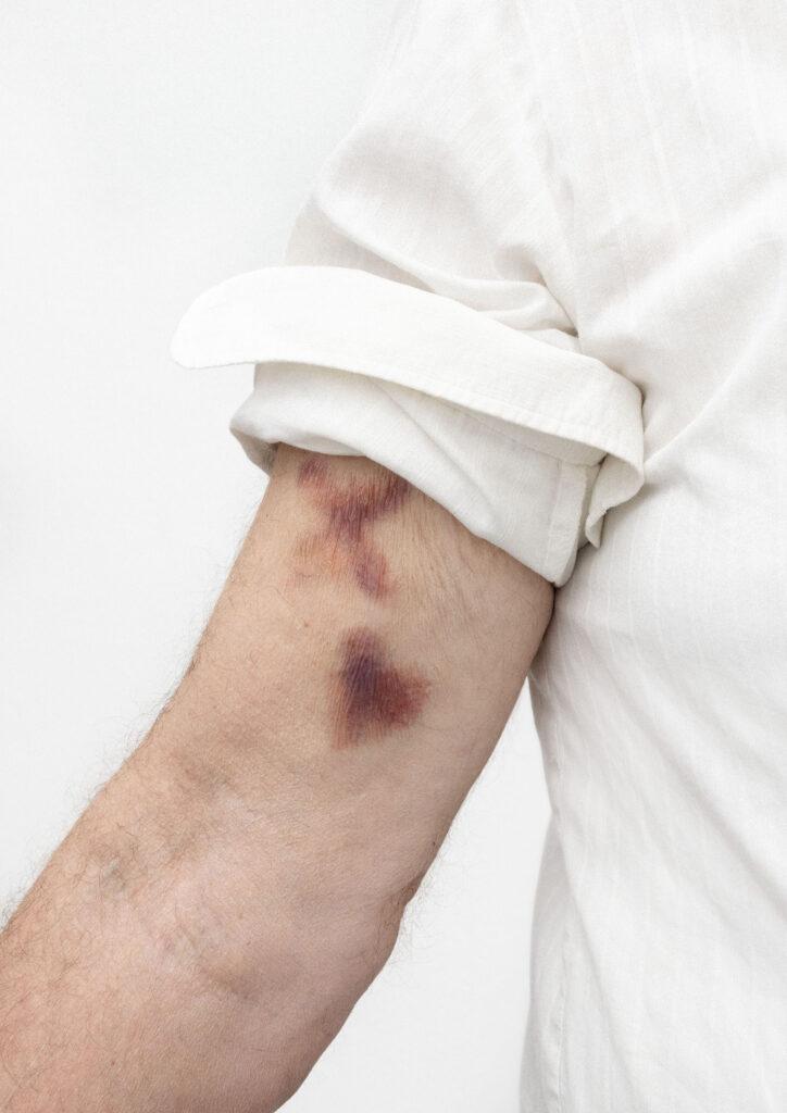 a_lielpetere_VWD_bruise_photos_4