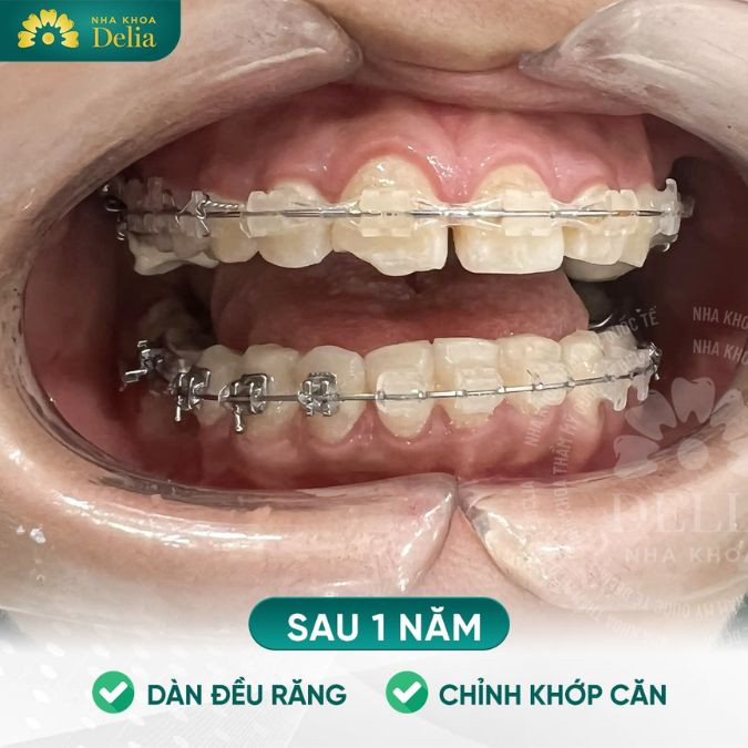 Phương pháp niềng răng mắc cài ảnh hưởng tới mức giá 