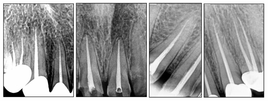 endodontics mohit