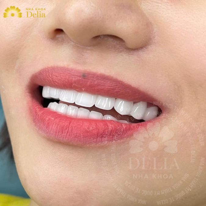 Miếng dán sứ siêu mỏng không gây ra tình trạng cộm vướng