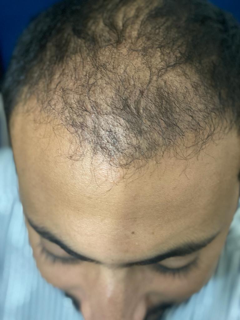 تساقط الشعر بعد زراعة الشعر - مركز اليت هير لزراعة الشعر