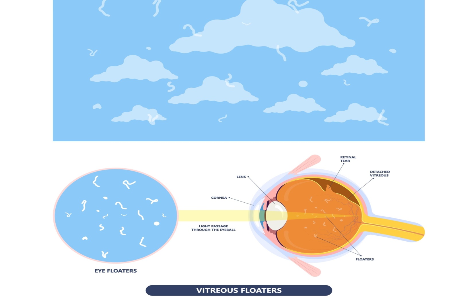 An illustration of what eye floaters look like in a person's vision as well as a diagram showing a detached vitreous humor causing floaters.