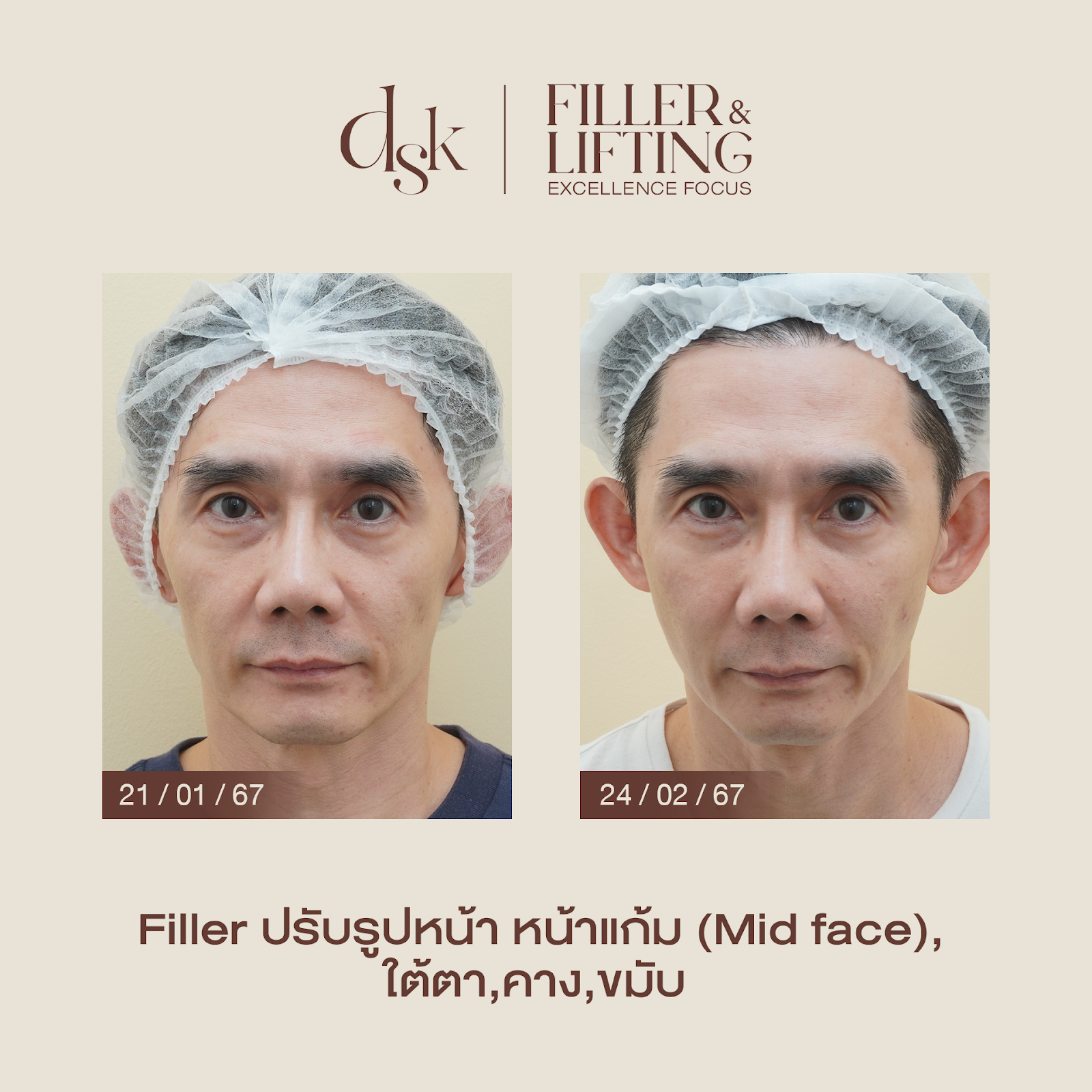 รีวิวฟิลเลอร์แก้มตอบที่ DSK Clinic